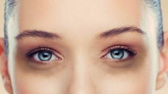 Göz altı morlukları nasıl geçer?